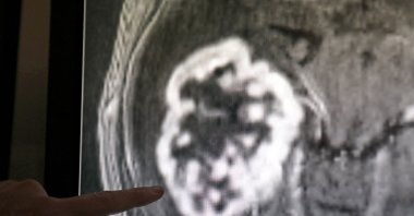 More than a million people under the age of 50 died from cancer in 2019, an increase of almost 28% compared to 1990. Unhealthy diets, lack of exercise and high blood sugar are among the causes, researchers believe. (dpa Photo)