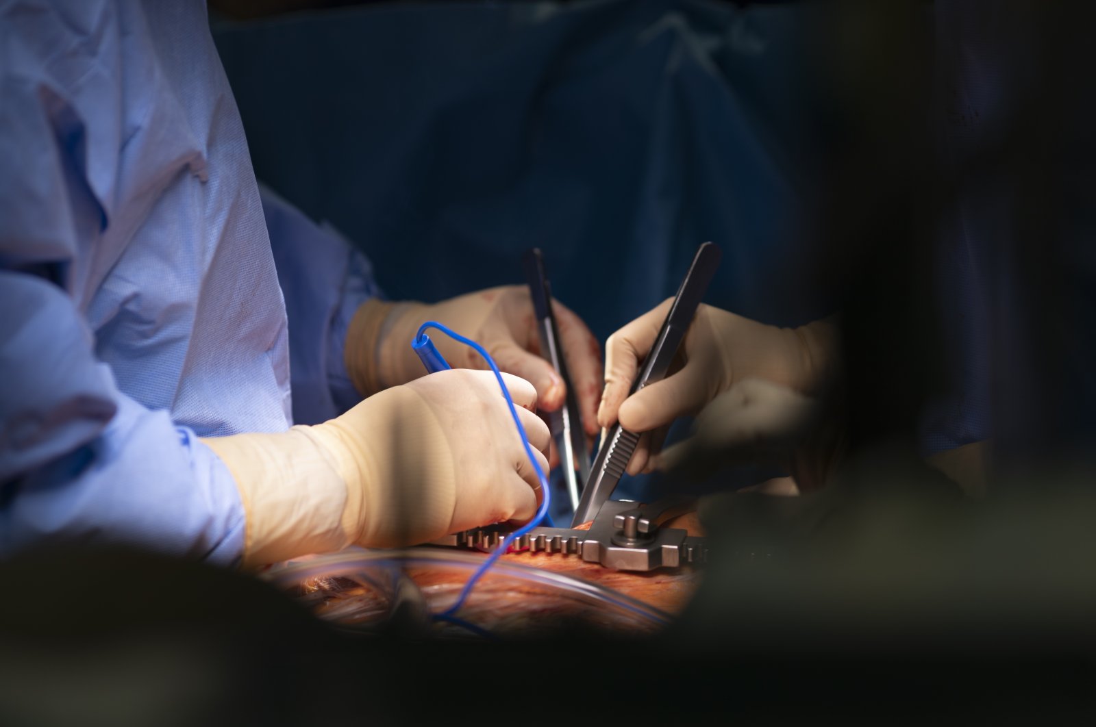 An undated photo of surgeons performing heart surgery. (Getty Photo)