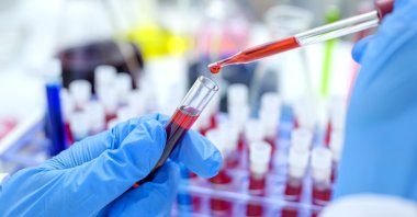 Significant treatments and studies are ongoing in the fields of vaccines, HIV prevention, containment and even complete cure. (Getty Images Photo)