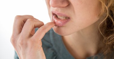 Mouth ulcers, also known as aphthous ulcers or canker sores, can appear on the inner lips, the base of your gums or the roof of your mouth. (dpa Photo)