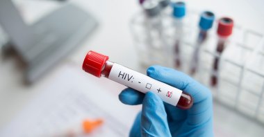 HIV is a virus that attacks the immune system, leading to acquired immunodeficiency syndrome (AIDS). (Shutterstock Photo)