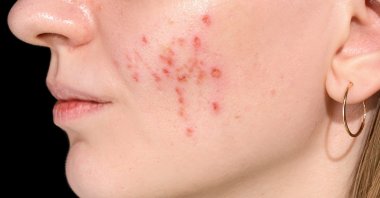 The breakdown of the skin barrier leads to a range of issues from eczema to severe acne, resulting in longer and more expensive treatments. (Shutterstock Photo)