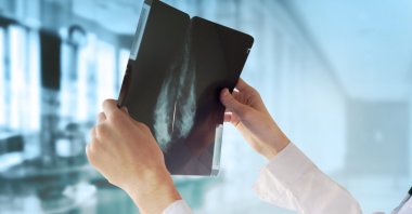 A high-fat diet is a &quot;high-risk factor for the malignant progression of cancers through the disruption of the intestinal microbiota,&quot; according to the researchers. (Shutterstock Photo)