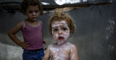 Displaced child Sham al-Hessi, center, who suffers from skin disease, is covered with skin cream as she poses for a picture, at a makeshift tent camp in Deir al-Balah, central Gaza Strip, Monday, July 29, 2024. (AP Photo)