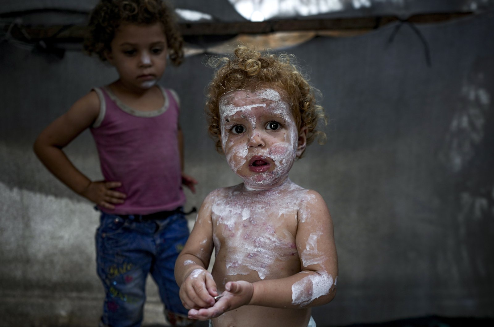 Displaced child Sham al-Hessi, center, who suffers from skin disease, is covered with skin cream as she poses for a picture, at a makeshift tent camp in Deir al-Balah, central Gaza Strip, Monday, July 29, 2024. (AP Photo)