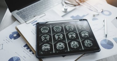 Close-up of a digital tablet displaying a brain X-ray on the screen. (Getty Images)