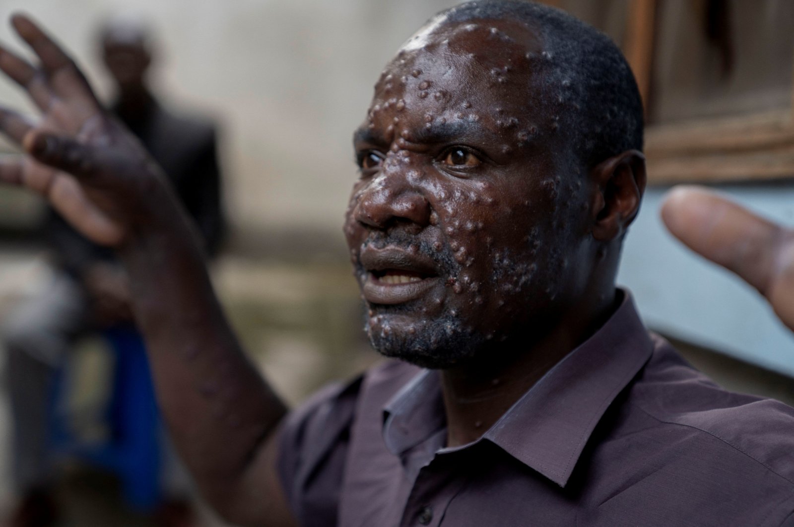 Jean Kakuru Biyambo, 48, from the Muja internally displaced person camp, gestures outside his room at the Goma General Hospital where he has been receiving treatment against mpox, Goma, Congo, July 16, 2024. (Reuters Photo)