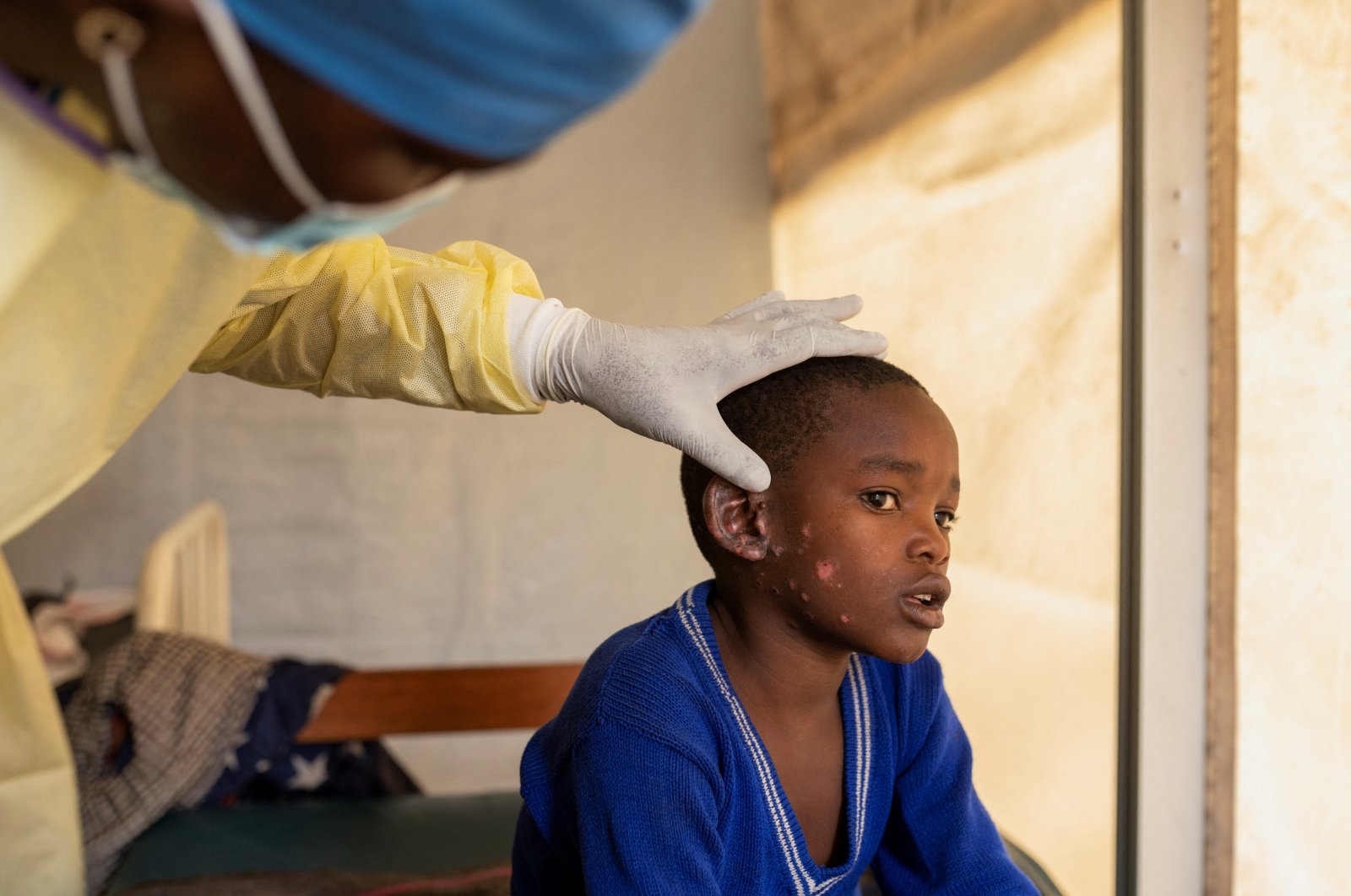 Dr. Tresor Wakilongo, verifies the evolution of skin lesions on the ear of Innocent, suffering from Mpox, North Kivu province, Democratic Republic of Congo, July 19, 2024. (Reuters Photo)