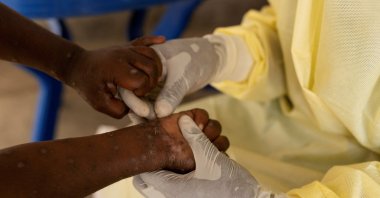 Christian Musema, a laboratory nurse, takes a sample from a child declared a suspected case of mpox at the treatment center in Munigi, Democratic Republic of Congo, July 19, 2024. (Reuters Photo)