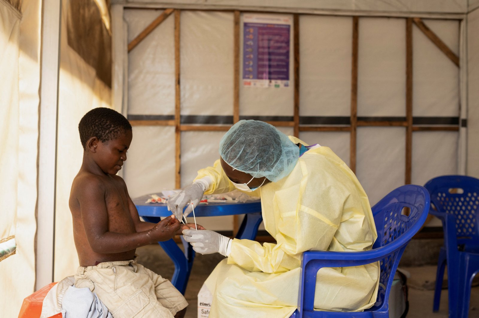 A laboratory nurse takes a sample from a child declared a suspected case of mpox at the treatment center in Munigi, Democratic Republic of the Congo, July 19, 2024. (Reuters Photo)