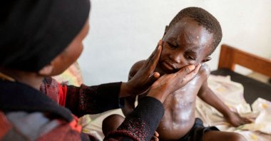 Furaha Elisabeth applies medication on the skin of her child Sagesse Hakizimana to treat mpox, Munigi, Nyiragongo territory, DRC, Aug. 19, 2024. (Reuters Photo)