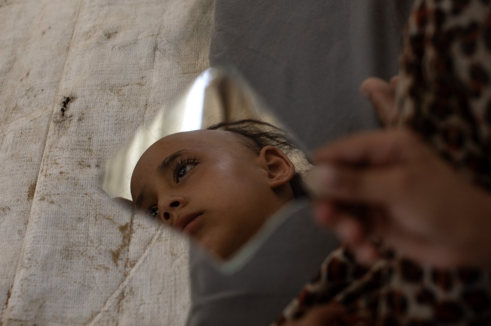 A 13-year-old displaced Palestinian girl, Sama Tabeel, who has suffered from panic attacks and hair loss due to Israeli attacks and evacuation orders, is seen in a mirror, at her family&#039;s accommodation in Khan Younis, northern Gaza, Palestine, Aug. 26, 2024. (EPA Photo)