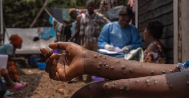A patient suffering from mpox sits on a bench at the Kavumu hospital, 30 km north of Bukavu in eastern Democratic Republic of Congo, Aug. 24, 2024. (AFP Photo)