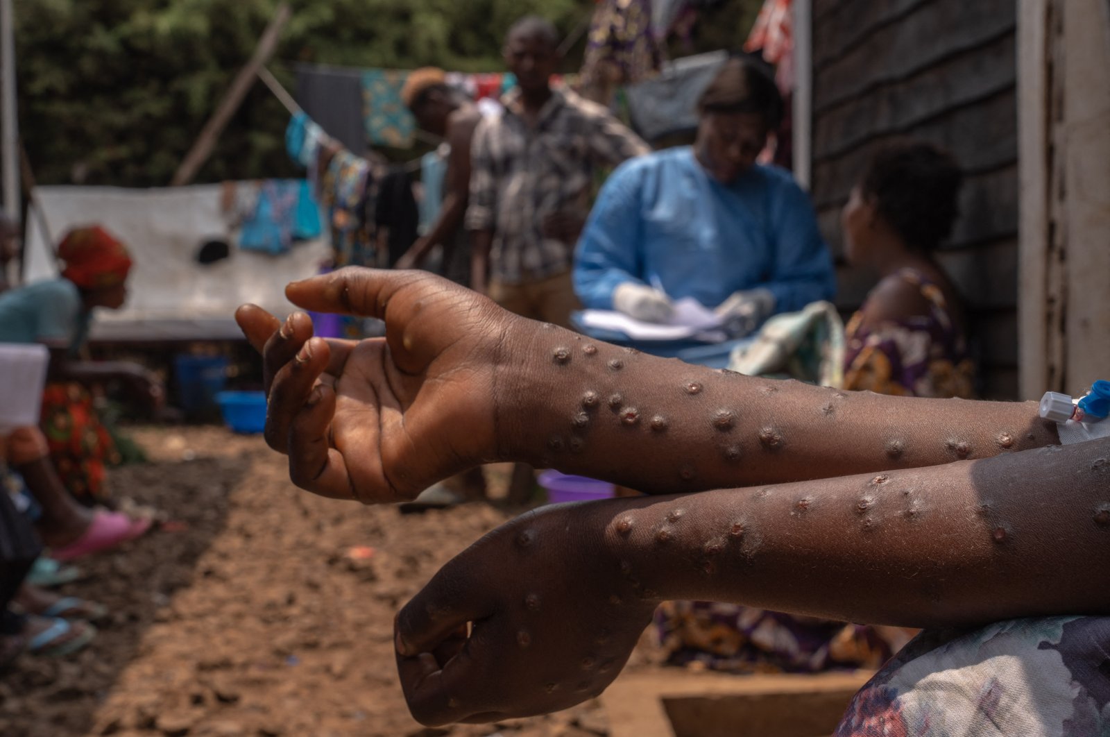 A patient suffering from mpox sits on a bench at the Kavumu hospital, 30 km north of Bukavu in eastern Democratic Republic of Congo, Aug. 24, 2024. (AFP Photo)