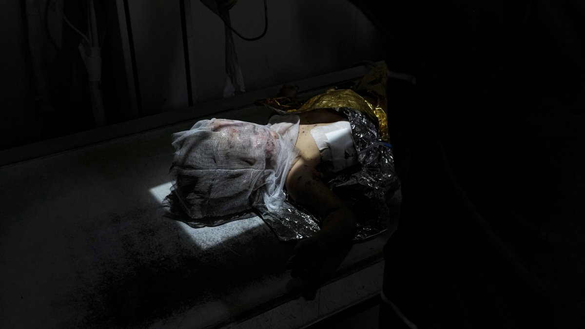 Palestinian child Siwar Abdel-Hadi, 2, wounded in the Israeli bombardment of the Gaza Strip, lies for an X-ray at a hospital in Deir al-Balah, July 24, 2024. (AP Photo)