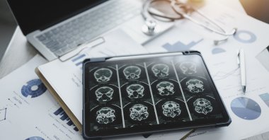 A digital tablet displays a brain X-ray. (Getty Images)