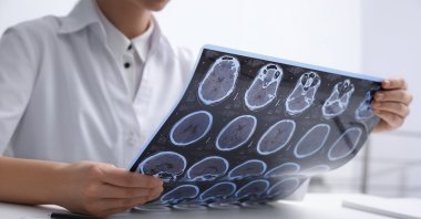 A new technique involving ultra-powerful MRI scanners could help doctors identify tiny differences in the brains of people with treatment-resistant epilepsy that may have otherwise been missed, a trial has found. (Shutterstock Photo)