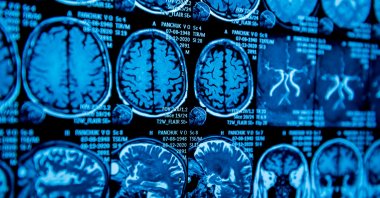 A brain implant using artificial intelligence was able to turn a paralyzed woman&#039;s thoughts into nearly simultaneous speech. (Shutterstock Photo)