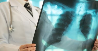 Early screening, especially with lung CT scans for high-risk individuals over 40, is vital to saving lives from this silent disease. (Shutterstock Photo)
