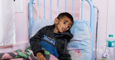 Palestinian boy Osama Al-Reqep, 5, lies on a bed at Nasser Hospital where he receives treatment, Khan Younis, Gaza Strip, Palestine, May 1, 2025. (Reuters Photo)