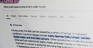 A health-related query on Google is displayed on a computer screen in New York, U.S., April 24, 2025. (AP Photo)