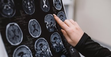 A doctor examines a close-up MRI of the brain as part of research on early cellular changes in neurodegenerative diseases. (Shutterstcok Photo) 