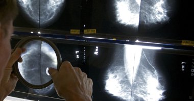 A radiologist uses a magnifying glass to check mammograms for breast cancer, Los Angeles, U.S., May 6, 2010. (AP Photo)