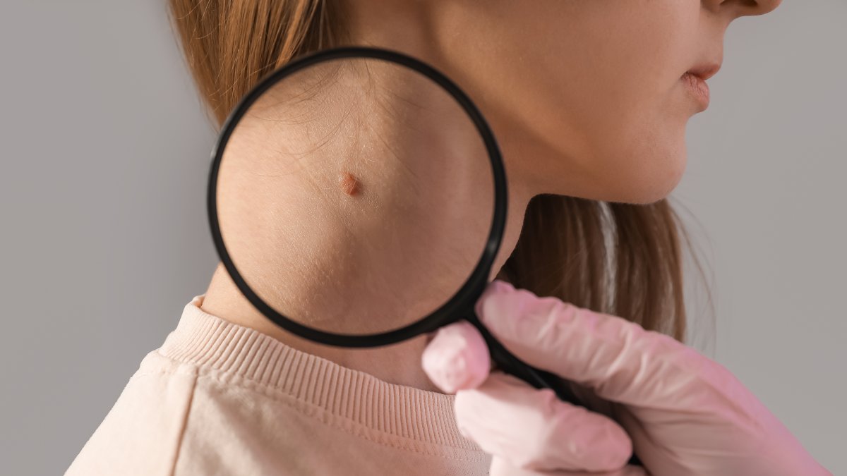 Although skin cancer typically occurs in areas exposed to the sun, it can also develop in areas that are not regularly exposed. (Shutterstock Photo)