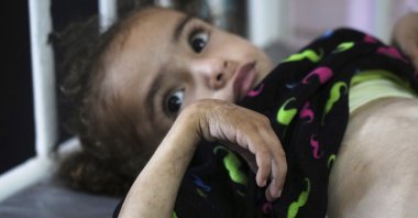 Mayar Al-Arja, 2, who suffers from malnutrition, lies on a bed in a clinic in Nasser Hospital, Khan Younis, Gaza, Palestine, May 21, 2025. (AP Photo)