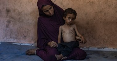Palestinian child Yazan Abu Foul, aged 2, is cared for by his mother Naima, as he suffers from severe malnutrition due to the acute shortage of food caused by the Israeli blockade on the Gaza Strip, in al-Shati refugee camp, west of Gaza City, July 19, 2025. (EPA Photo)
