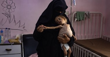 A 2-year-old Palestinian child is held by her mother at the Nasser Hospital in Khan Younis, Gaza Strip, Palestine, Aug. 10, 2025. (EPA Photo)