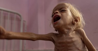 Sham Qudeih, a two-year-old Palestinian child, cries out while sitting on a hospital bed at the Nasser Hospital in Khan Younis, southern Gaza Strip, Aug.10, 2025. (EPA Photo)