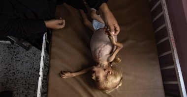 Sham Qudeih, a 2-year-old Palestinian child who suffers from liver enlargement, severe malnutrition and severe abdominal swelling, with her weight having dropped to 4 kilograms, lies on a bed at the Nasser Hospital, Khan Younis, southern Gaza Strip, Gaza, Palestine, Aug. 10, 2025. (EPA Photo)