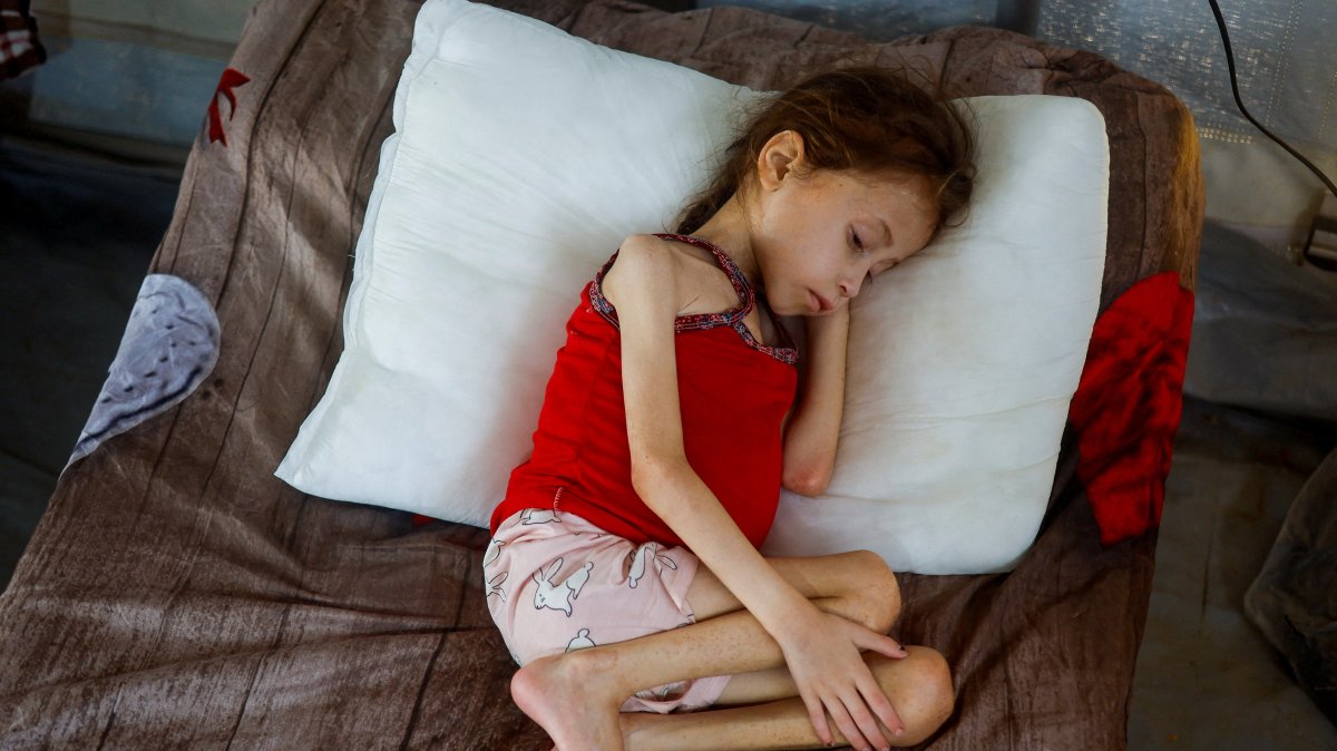 Jana Ayad, a malnourished Palestinian girl, rests on a bed as she receives treatment at the International Medical Corps field hospital, amid Israel&#039;s genocidal war, Deir Al-Balah, Gaza, Palestine, June 22, 2024. (Reuters Photo)