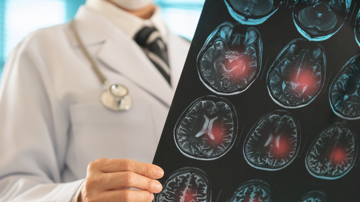 A doctor examines a brain X-ray to diagnose ischemic stroke, cerebrovascular disease and Alzheimer’s. (Shutterstock Photo)