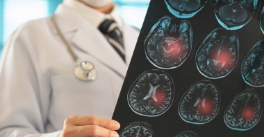 A doctor examines a brain X-ray to diagnose ischemic stroke, cerebrovascular disease and Alzheimer’s. (Shutterstock Photo)