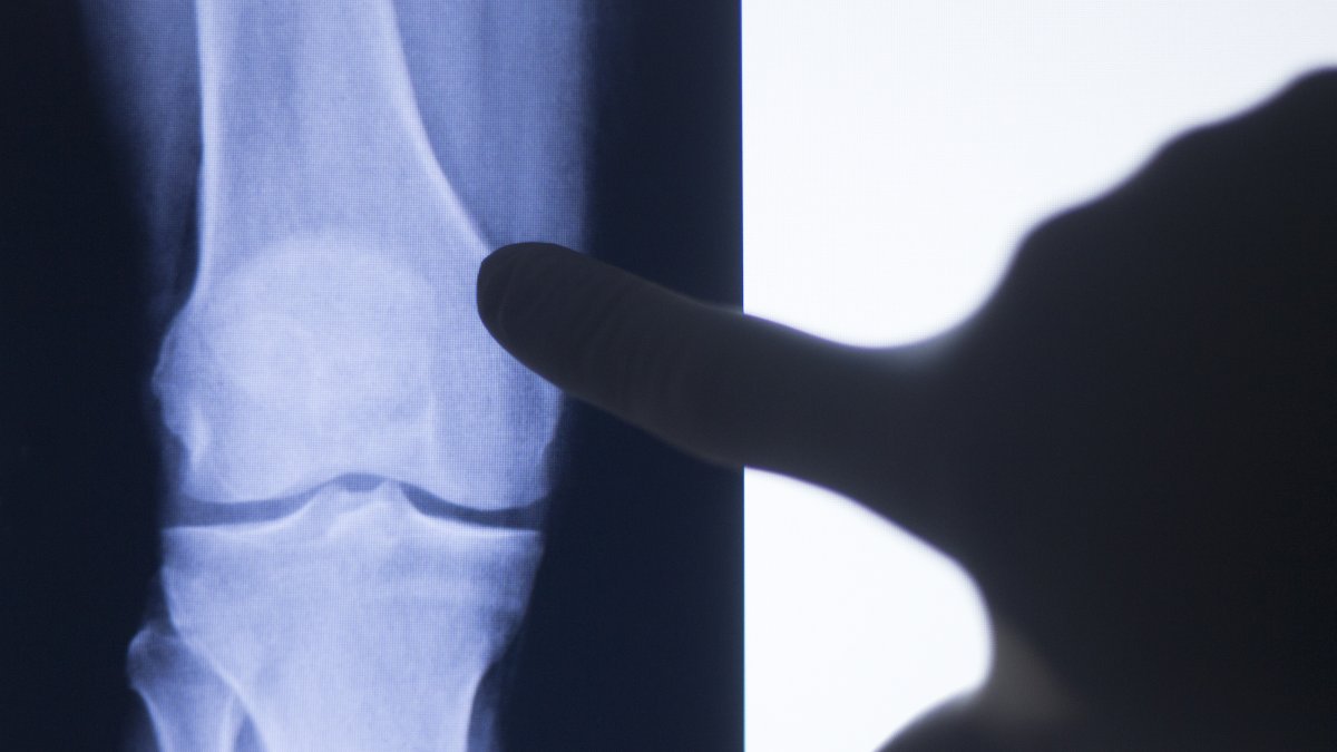 A surgeon reviews knee X-ray scans of a patient with arthritis and joint pain, examining the condition on screen. (Shutterstock Photo)