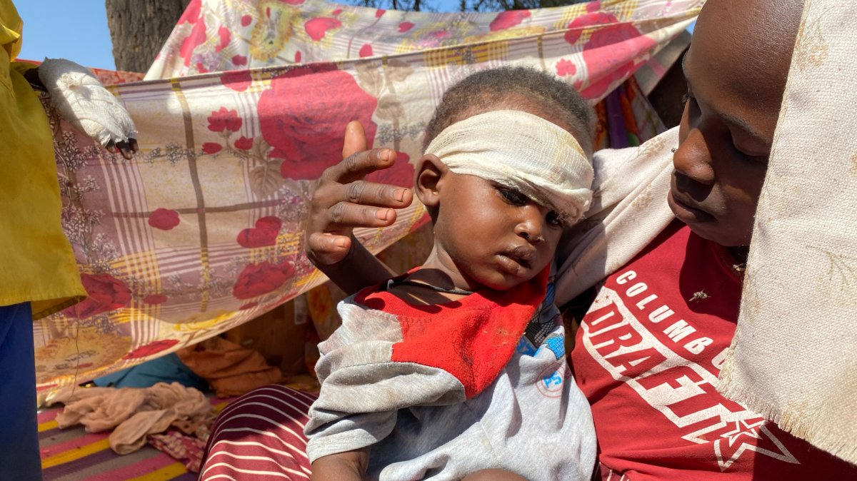 A Sudanese child who fled el-Fasher city with family after Sudan's paramilitary forces killed hundreds of people in the western Darfur region, receives treatment at a camp in Tawila, Sudan, Nov. 2, 2025. (AP Photo)