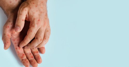 Canada has officially lost its “measles-free” status due to a rise in measles cases across the country over the past year. (Shutterstock Photo)