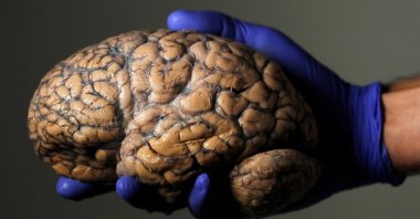 A researcher holds a human brain, part of a collection of more than 3,000 brains at the psychiatric hospital in Duffel, Belgium, July 19, 2017. (Reuters File Photo)
