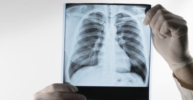 A specialist reviews a lung X-ray to diagnose and manage lymphangioleiomyomatosis (LAM). (Shutterstock Photo)
