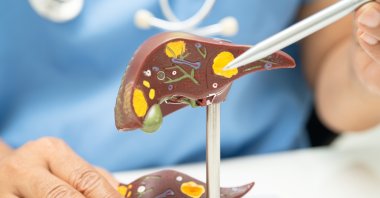 A doctor shows the liver anatomy model while explaining fatty liver. (Shutterstock Photo) 