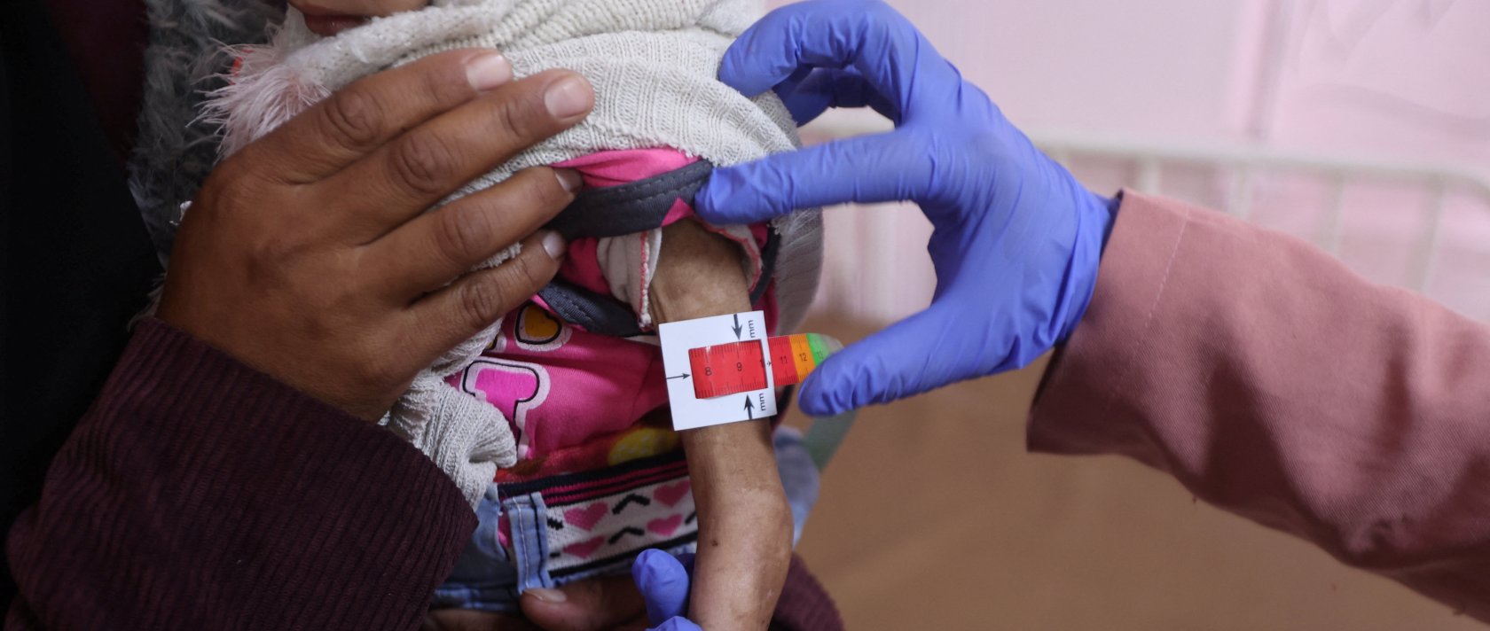 Arjwan al-Dahini, a Palestinian child, who doctors say suffers from severe acute malnutrition, is held by her mother during a medical examination at Nasser Hospital in Khan Younis, southern Gaza Strip, Dec. 16, 2025. (Reuters Photo)