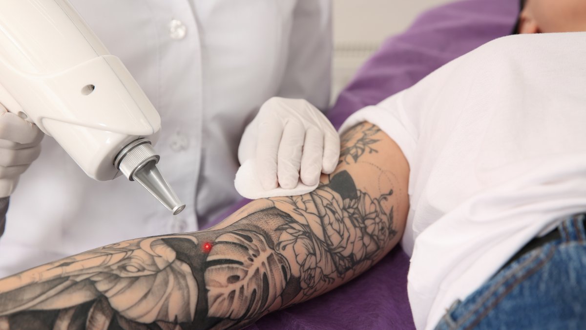 Tattoo removal likely is almost as old as the practice of inking and included scraping the skin to get the pigments off or out. (Shutterstock Photo)