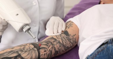 Tattoo removal likely is almost as old as the practice of inking and included scraping the skin to get the pigments off or out. (Shutterstock Photo)