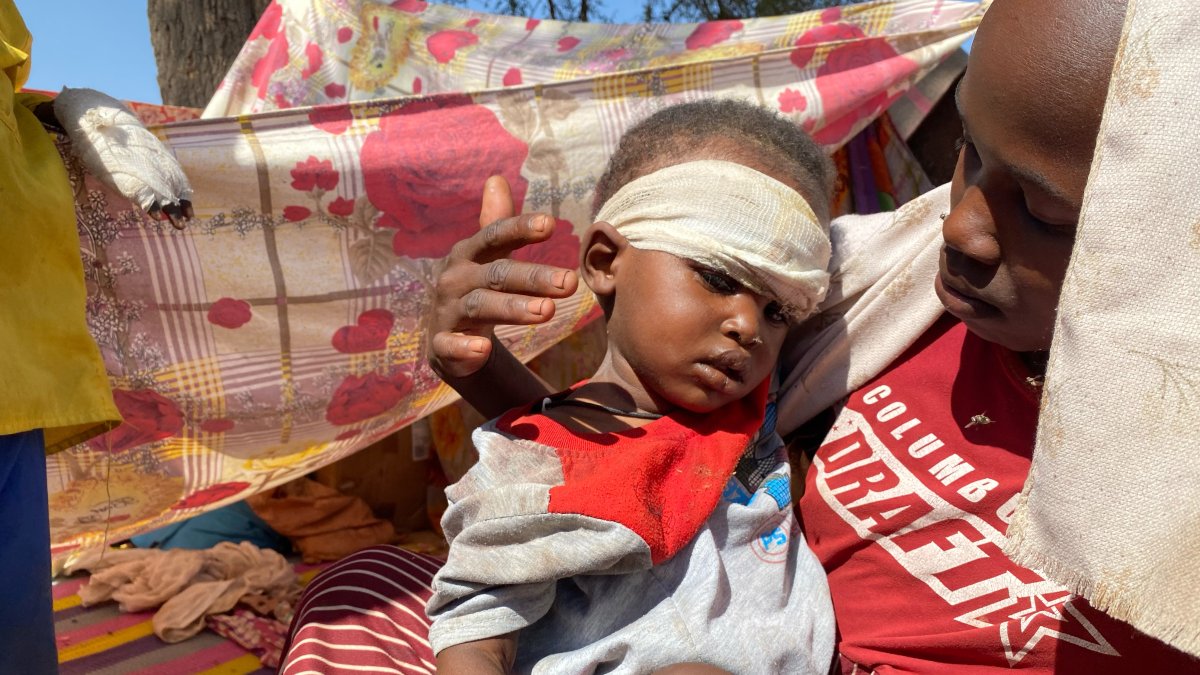 A Sudanese child who fled el-Fasher city with family after Sudan's paramilitary forces killed hundreds of people in the western Darfur region, receives treatment at a camp in Tawila, Sudan, Nov. 2, 2025. (AP Photo)