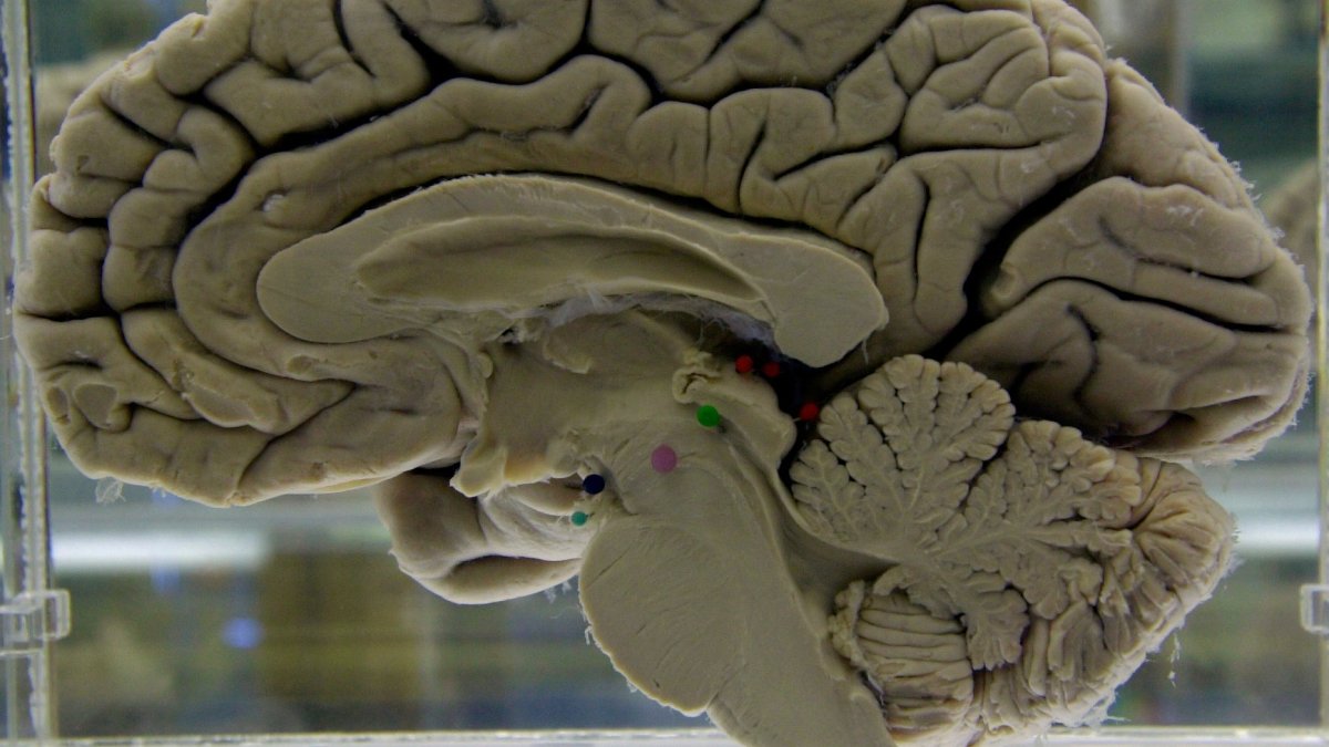 A section of a preserved human brain on display at the Museum of Neuroanatomy at the University at Buffalo, U.S., Oct. 7, 2003. (AP Photo)