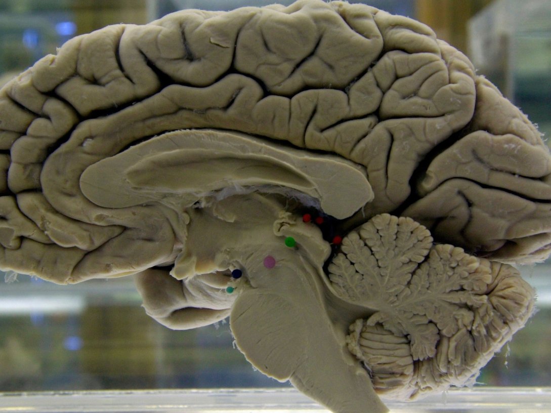 A section of a preserved human brain on display at the Museum of Neuroanatomy at the University at Buffalo, U.S., Oct. 7, 2003. (AP Photo)
