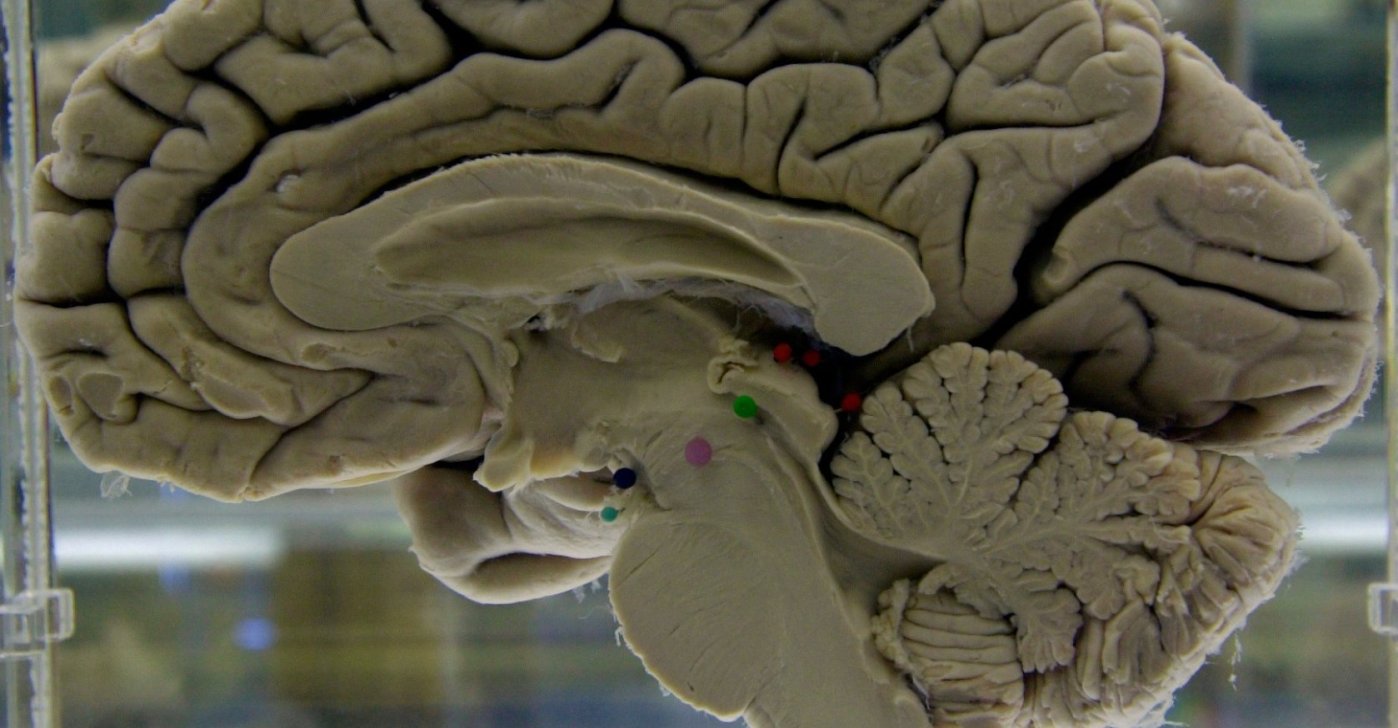 A section of a preserved human brain on display at the Museum of Neuroanatomy at the University at Buffalo, U.S., Oct. 7, 2003. (AP Photo)