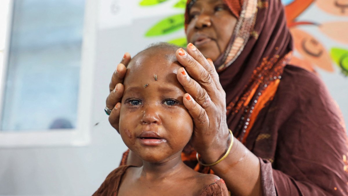 An internally displaced Somali woman holds the head of her malnourished child at the Daynile hospital as shortages of lifesaving therapeutic foods caused by shipping disruptions due to the Iran war have forced clinics treating severely malnourished children to turn away patients and ration supplies, Daynile district of Mogadishu, Somalia, April 20, 2026. (Reuters Photo)